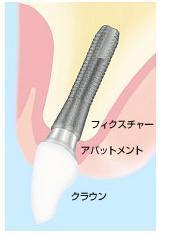 インプラント
